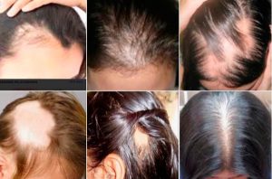 tratamiento de caida de pelo que puedes comprar