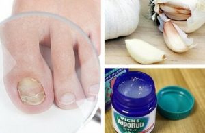 La mejor lista de crema para hongos en las uñas de los pies para comprar on-line – Los 30 más vendidos