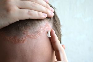 Opiniones y reviews de dermatitis seborreica y caida de pelo para comprar
